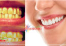 क्या आपके दांत भी हो रहे हैं पीले? तो इन 5 तरीकों को अपना कर पा सकते हैं एकदम सफेद दांत